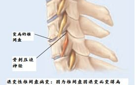 神经根型颈椎病症状,症状解析与自我防护指南